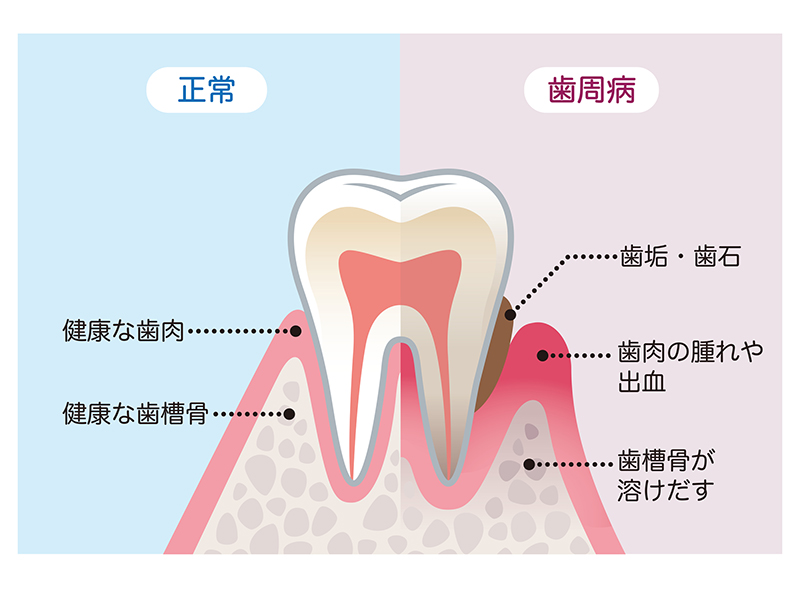 歯周治療