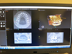 歯科用CTとは？