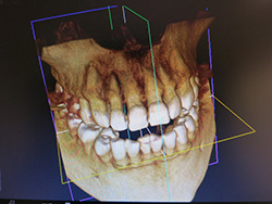 歯科用CTとは？