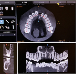 歯科用ＣＴ外来