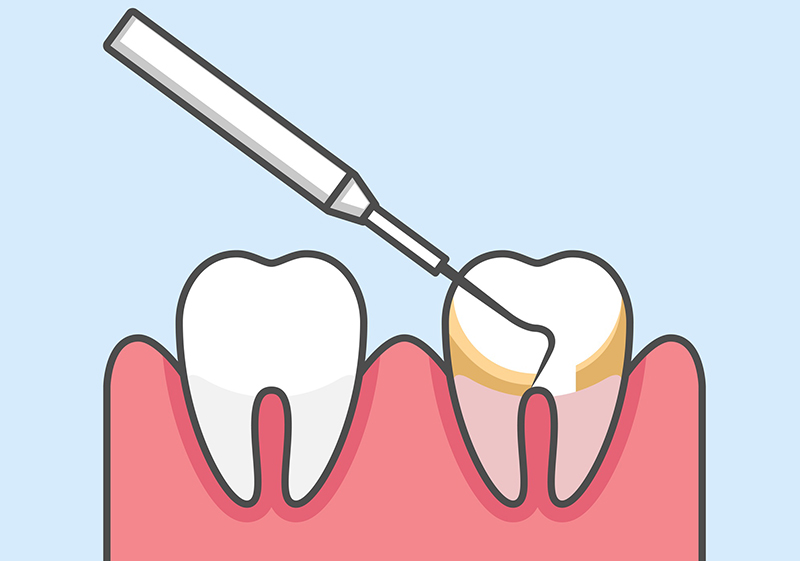歯石がついたままだとどうなるの？|千葉のアミーズ歯科クリニック