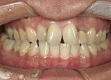 前歯の離開の症例