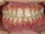 前歯が突出し、歯茎の色、歯の色が気になって来院された症例
