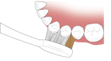 （３）上から見るとこのように歯面にあてますＶ字状に歯の表面に密着しています。