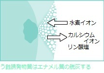 iconによる虫歯治療