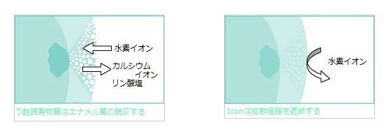 ｉｃｏｎによる虫歯治療