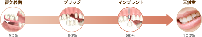 インプラントは噛む力が違います