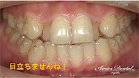 インビザライン装置