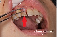ケースリファイメント②歯の挺出不足によるエアースペースの発生