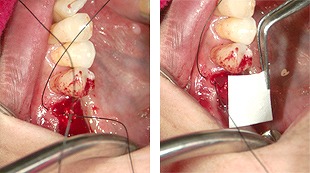 GTR法（歯周組織再生誘導法）