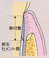 GTR法（歯周組織再生誘導法）