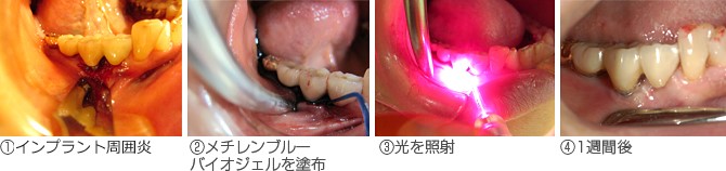 インプラント周囲炎（他院からの患者様）