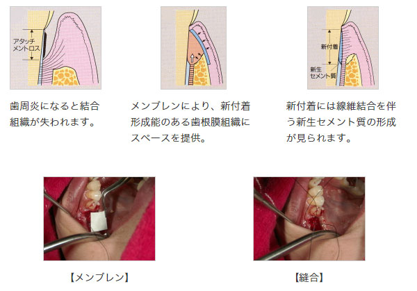 （1）ＧＴＲ法（歯周組織再生誘導法）