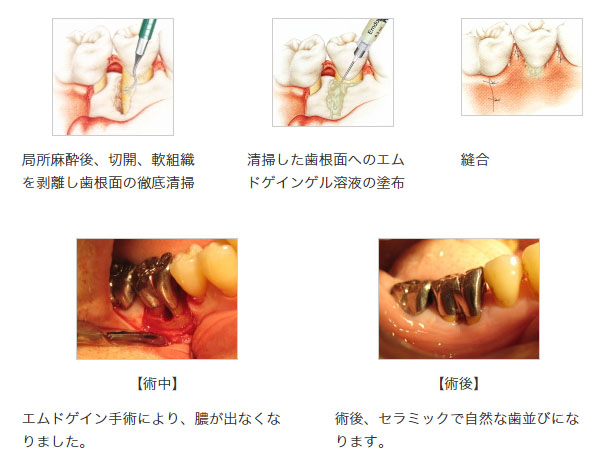 （B）エムドゲイン法（歯周組織再生誘導材料：EMDOGAIN）