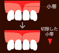 切除した小帯