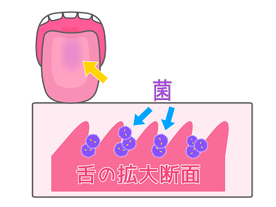 舌苔の放置