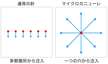 通常の針とマイクロカニューレの違い