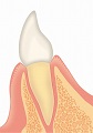 歯周病の進行