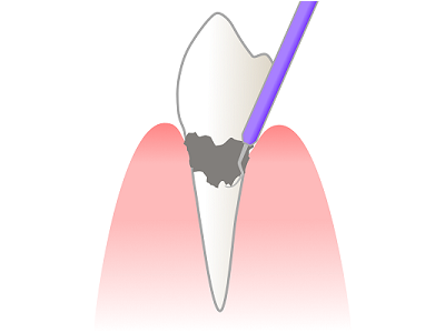 プラーク・歯石の放置