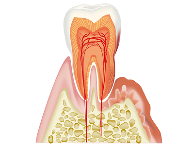 歯周病