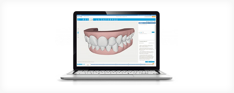 iTeroで無料簡易スキャン後、治療後の歯並びをシミュレーション